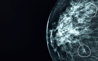 NHS AI test spots tiny cancers missed by doctors