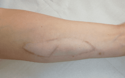 Arm skin patch could warn of organ rejection