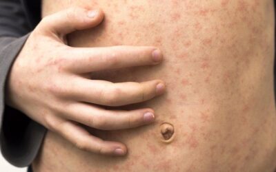 Measles outbreak declared as new cases confirmed